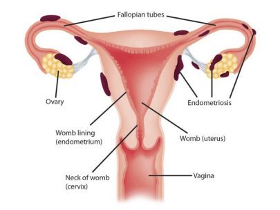 Endometrio en la mujer y perro